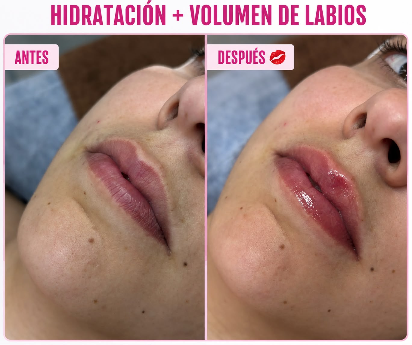 Reel de antes y después de estética