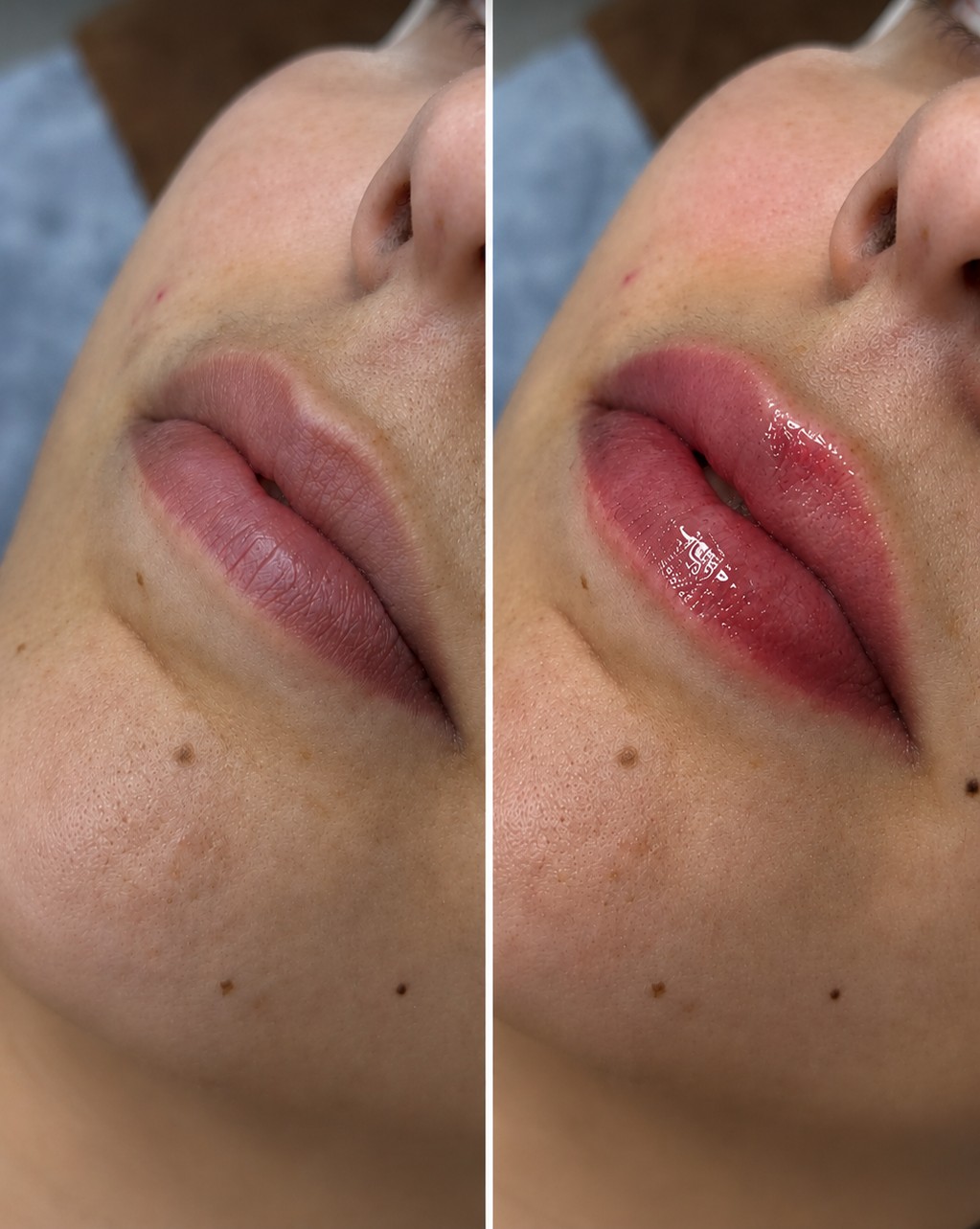 Antes y después de hidratación y volumen de labios